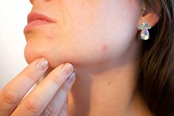 acne treatment solution 