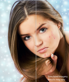 Clear Pores acne treatment solution 